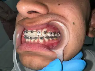 Manejo ortodóntico en casos complejos con brackets de autoligado — paso 2 de 4 · White Smile Odontología, Chapinero, Bogotá
