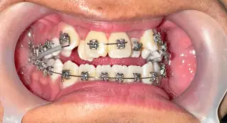 Manejo ortodóntico en casos complejos con brackets de autoligado — paso 3 de 4 · White Smile Odontología, Chapinero, Bogotá
