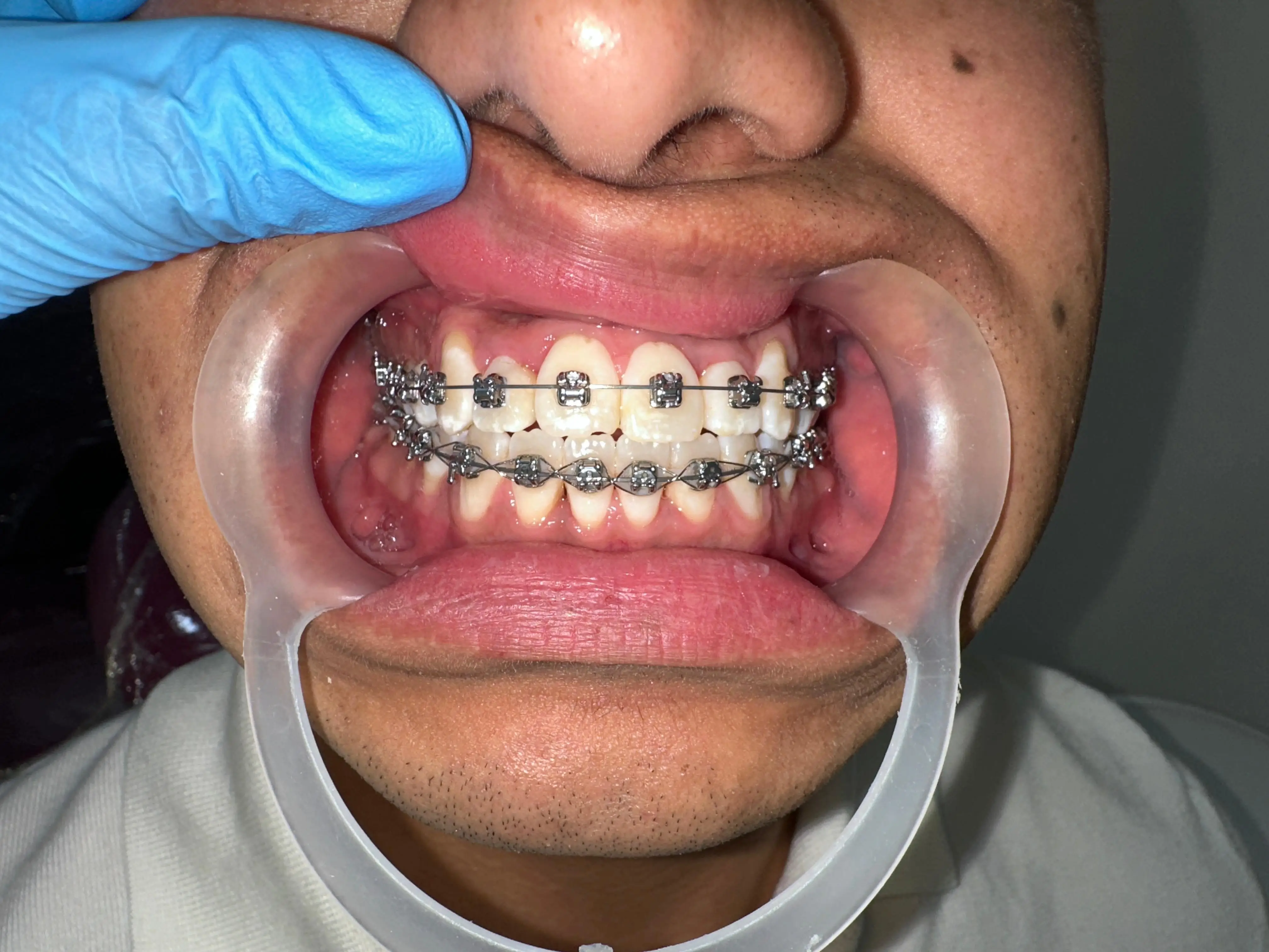 Manejo ortodóntico en casos complejos con brackets de autoligado — paso 1 de 4 · White Smile Odontología, Chapinero, Bogotá