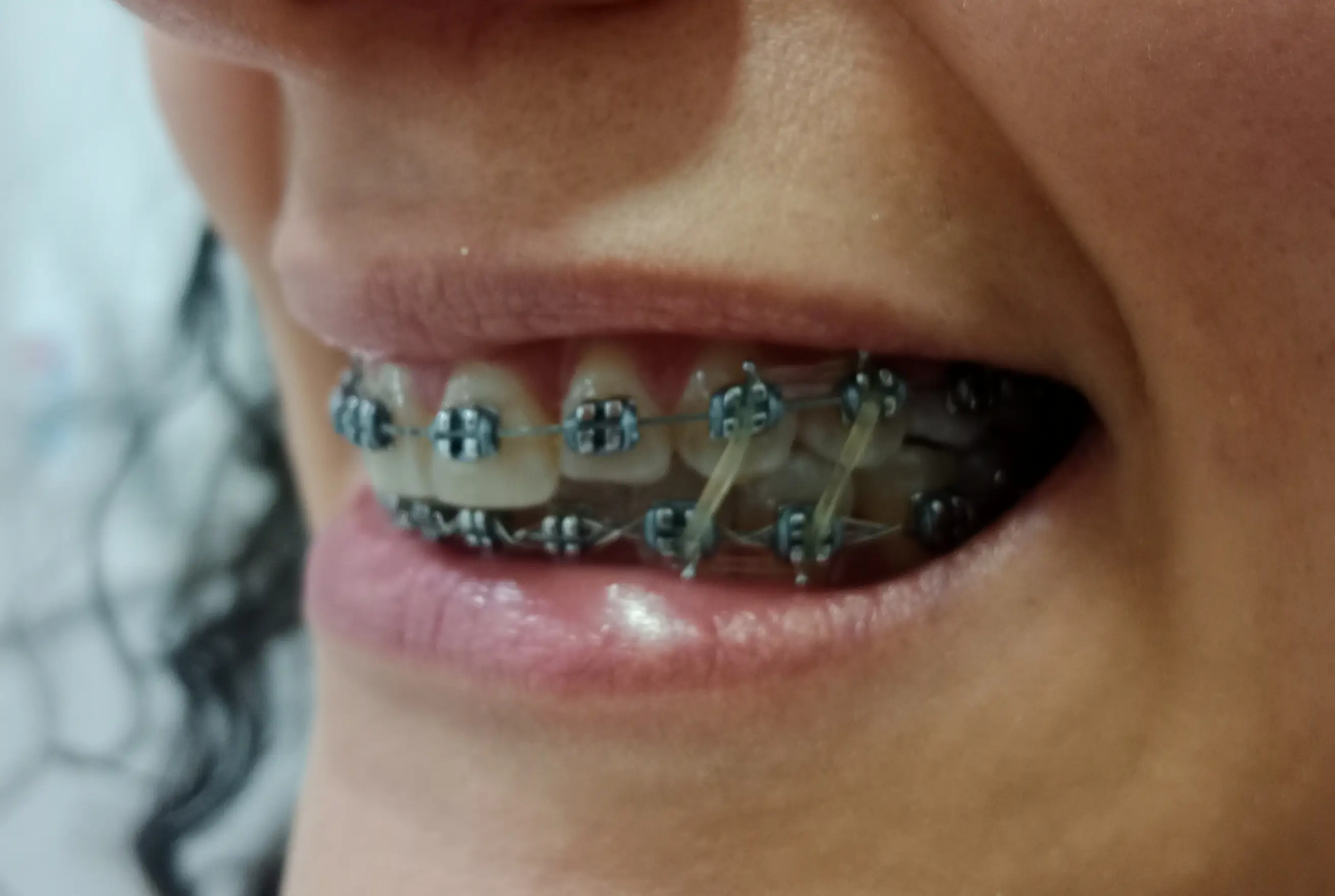Coronas en zirconio · White Smile Odontología, Chapinero, Bogotá