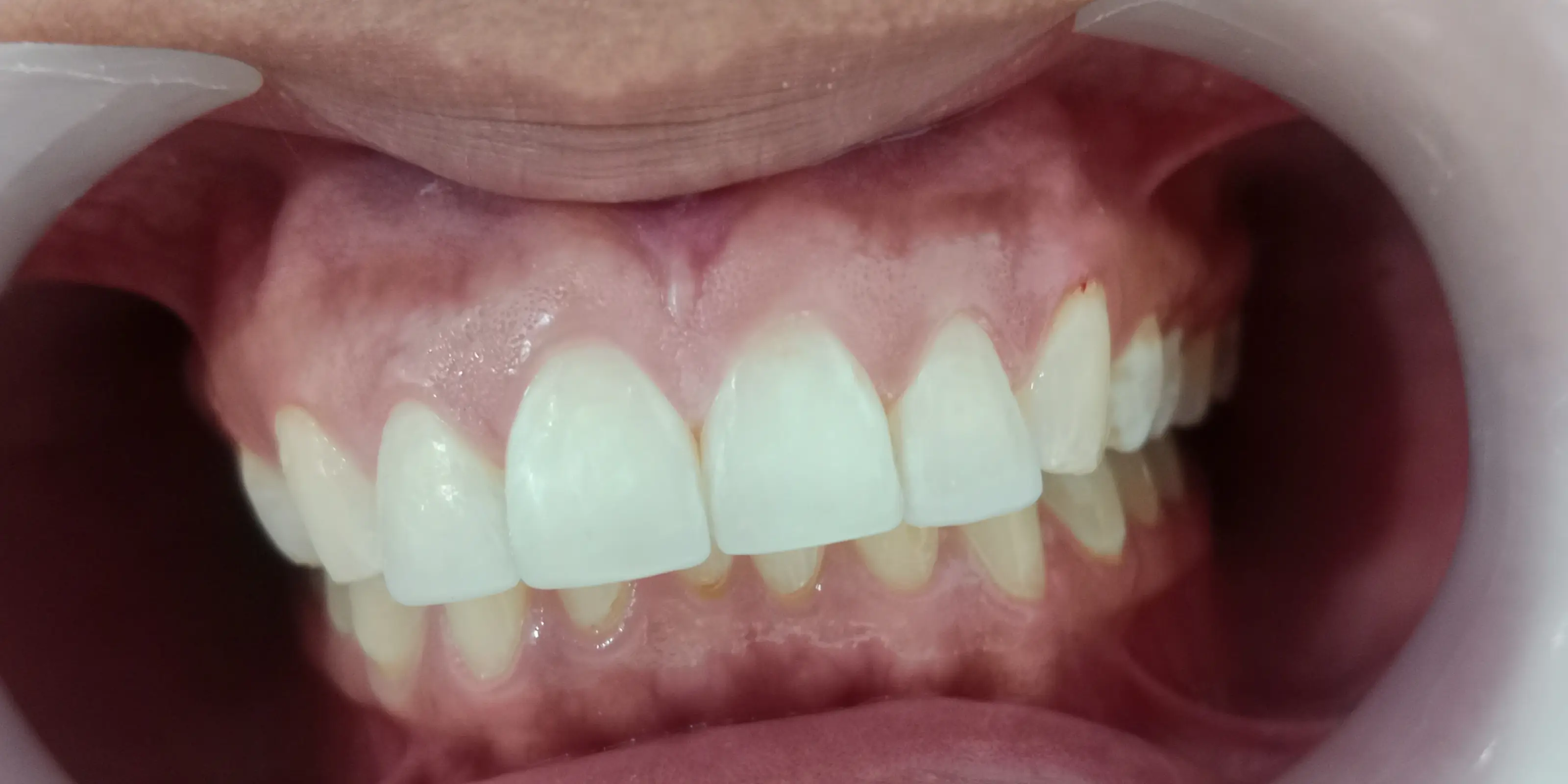 Aclaramiento dental en consultorio — paso 1 de 2 · White Smile Odontología, Chapinero, Bogotá