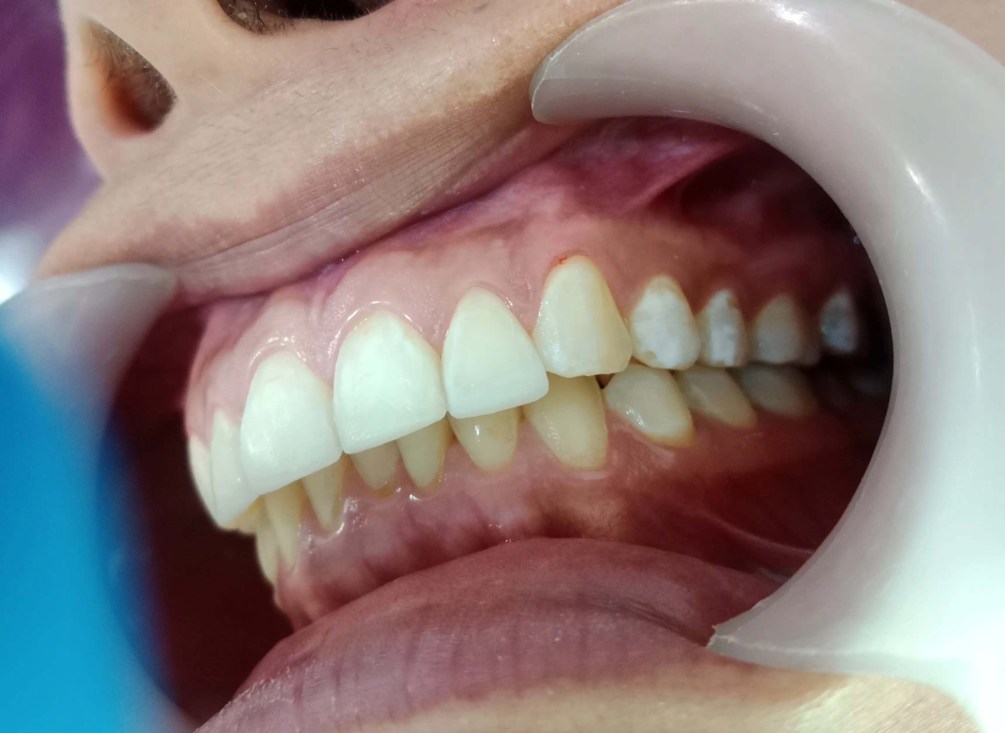 Profilaxis y control de placa · White Smile Odontología, Chapinero, Bogotá