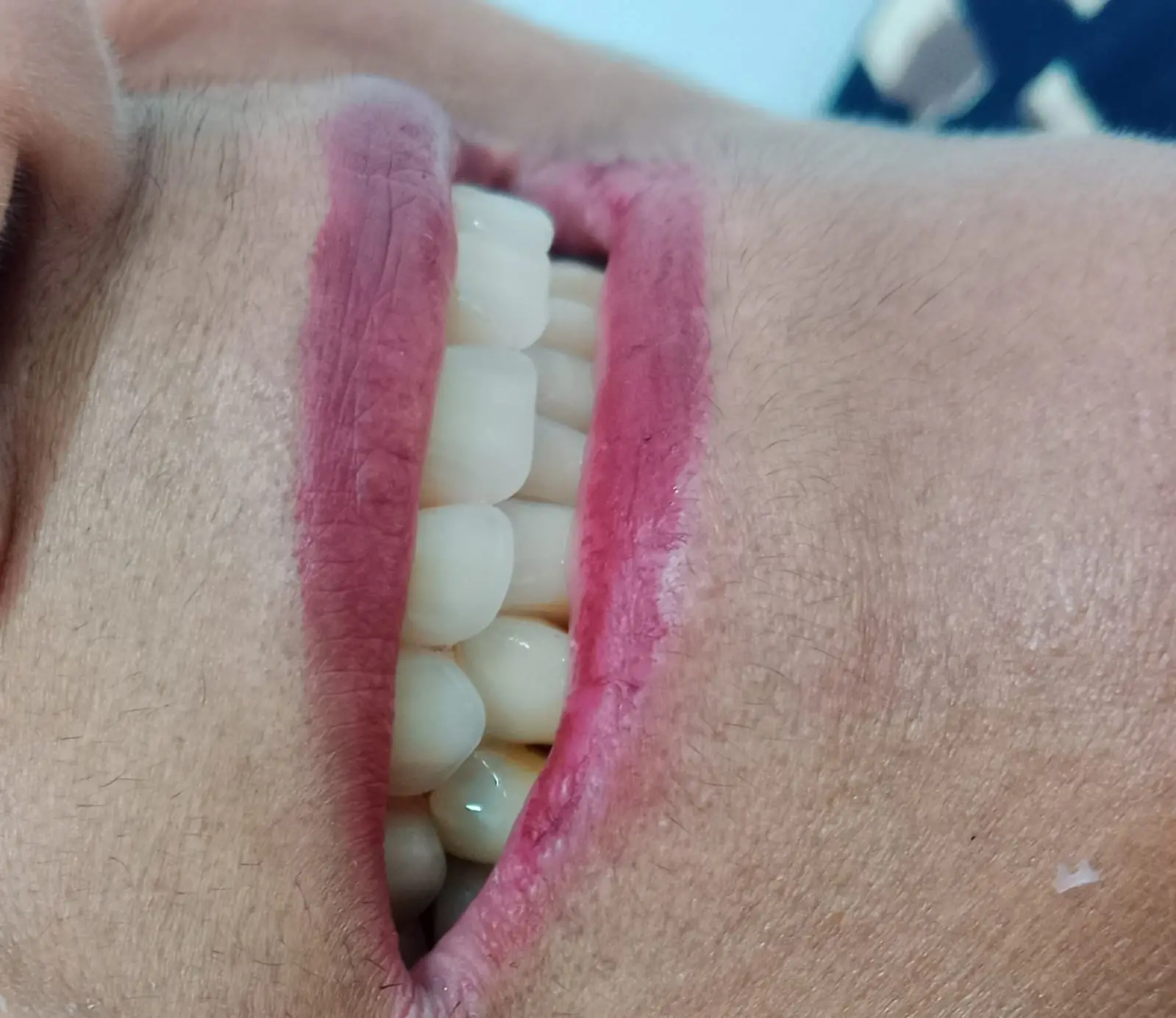 Prótesis total superior — paso 1 de 2 · White Smile Odontología, Chapinero, Bogotá