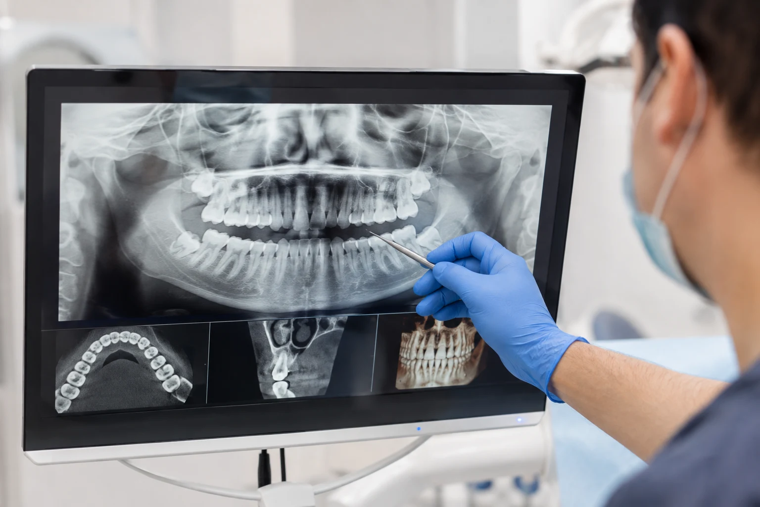 Cirugía oral para extracción de cordales