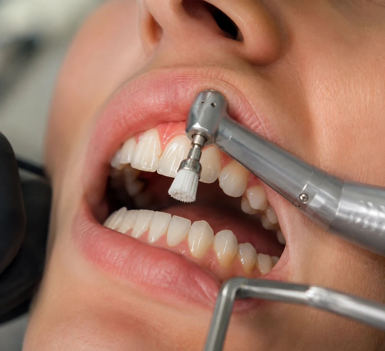 Tratamiento periodontal de encías inflamadas