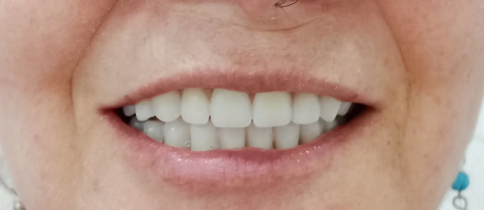 Tratamiento realizado en la clínica · White Smile Odontología, Chapinero, Bogotá